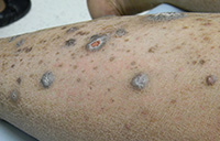 Hypertrophic lichen planus with intralesional corticosteroid induced hypopigmentation